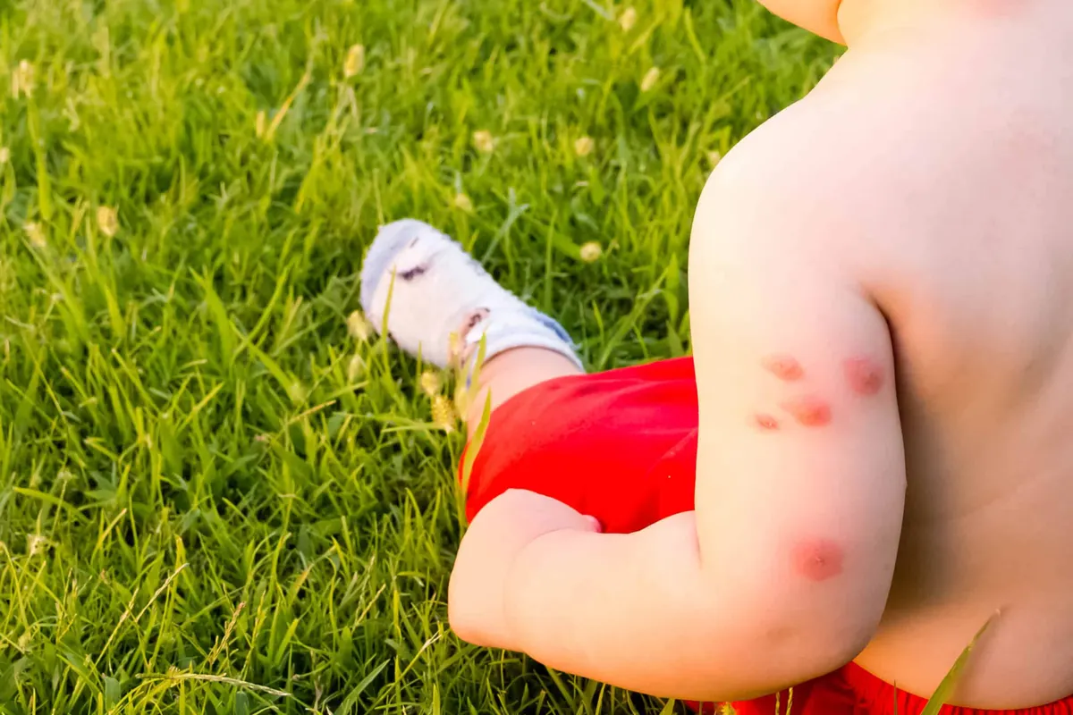Top Ten Most Painful Insect Bites and How to Manage Them